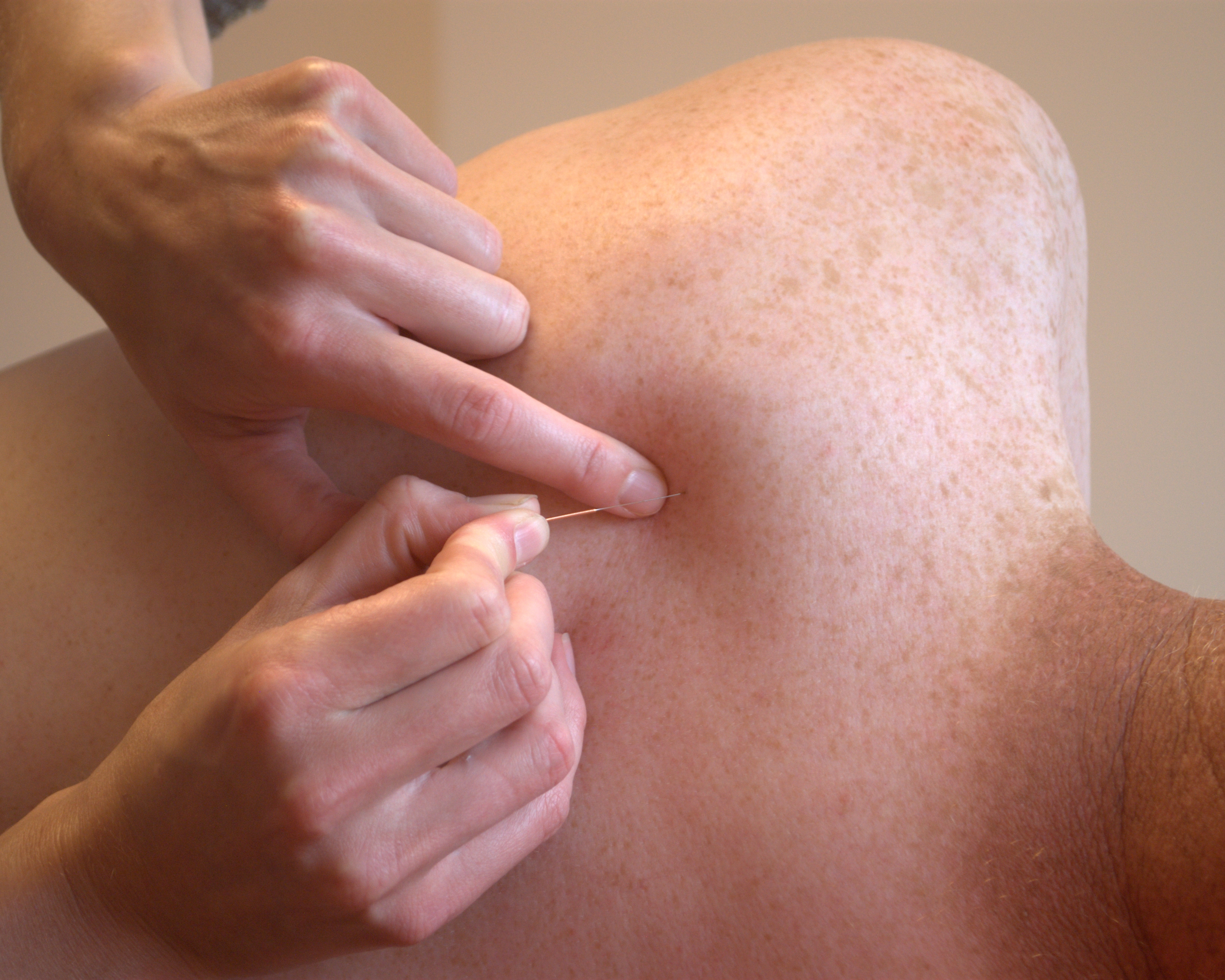 Praktijk Dry needling